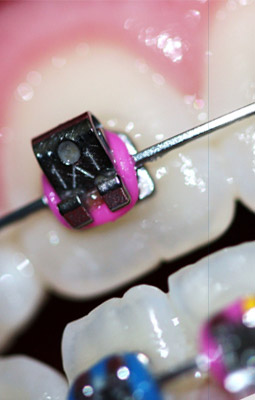Aparat ortodontyczny z kolorowymi gumkami